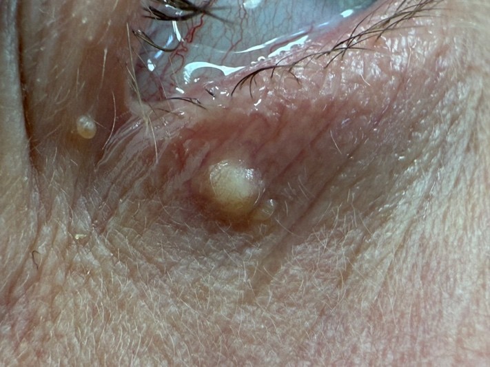 Usunięcie prosaka na dolnej powiece prawego oka